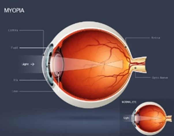 Myopia Management - Eyes 4 Kids